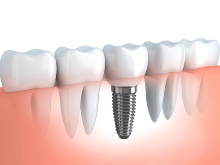 Implantologie - Zahnarztpraxis Willich Schiefbahn